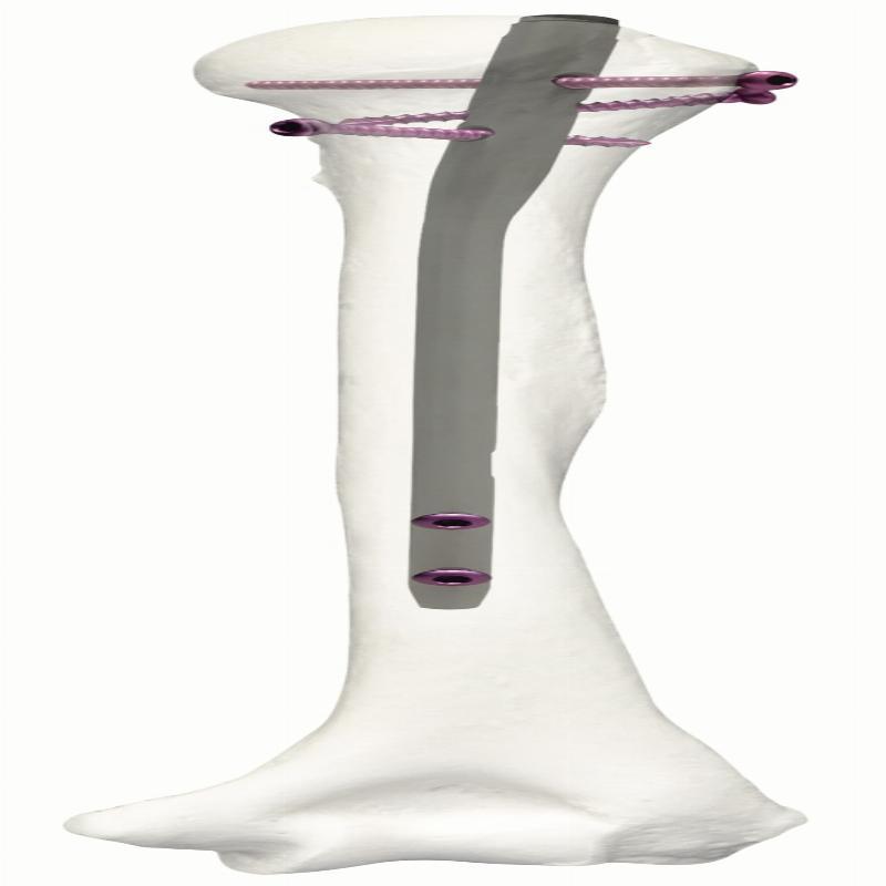 Auxein - JIN Тип – Плечовий Стрижень